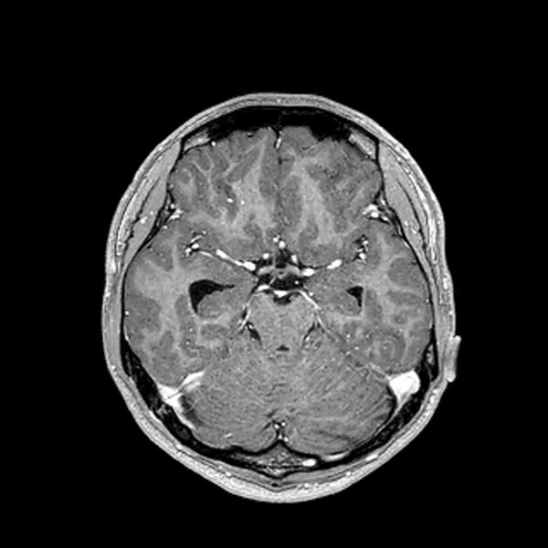 File:Central neurocytoma (Radiopaedia 79320-92380 Axial T1 C+ 99).jpg