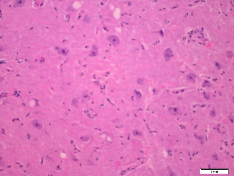 File:Cerebellar gangliocytoma (Radiopaedia 65377-74423 B 1).jpg