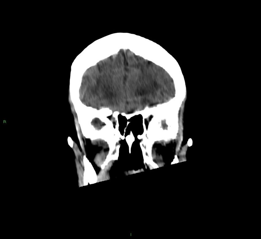Cerebellar hemorrhage (Radiopaedia 58792-66026 Coronal non-contrast 47).jpg