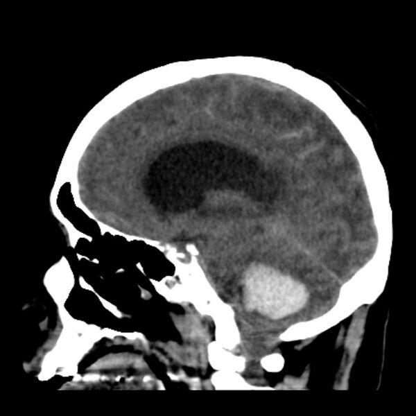File:Cerebellar hemorrhage causing obstructive hydrocephalus (Radiopaedia 33989-35207 B 22).jpg