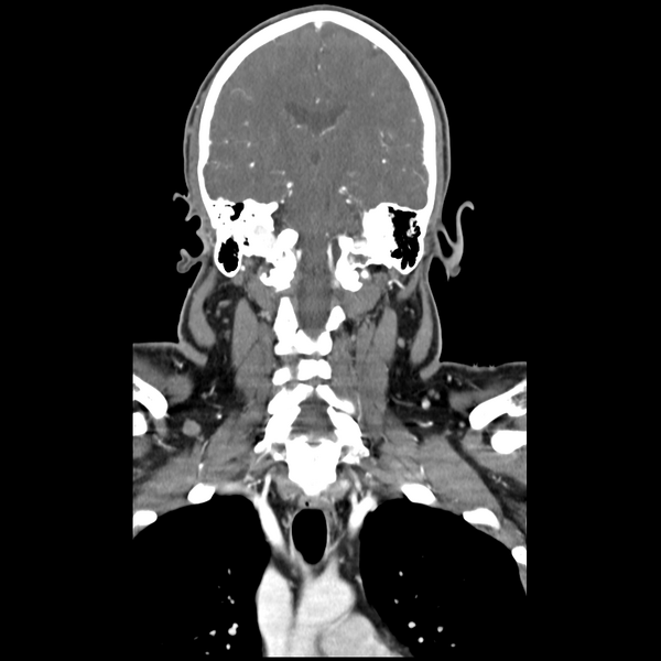 File:Cerebellar infarct due to vertebral artery dissection with posterior fossa decompression (Radiopaedia 82779-97029 D 35).png