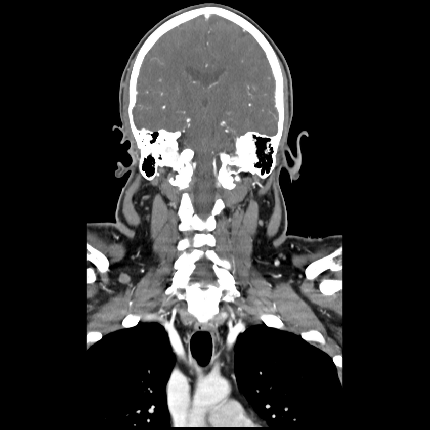 Cerebellar infarct due to vertebral artery dissection with posterior fossa decompression (Radiopaedia 82779-97029 D 35).png