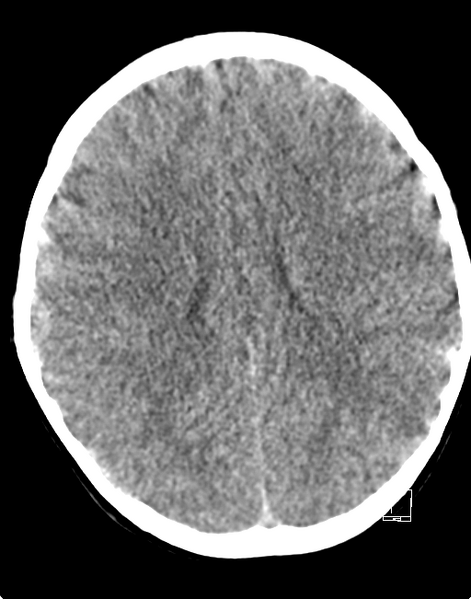 File:Cerebellar stroke (Radiopaedia 32202-33149 Axial non-contrast 17).png