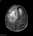 Cerebral abscesses secondary to contusions (Radiopaedia 5201-6968 Axial FLAIR 3).jpg