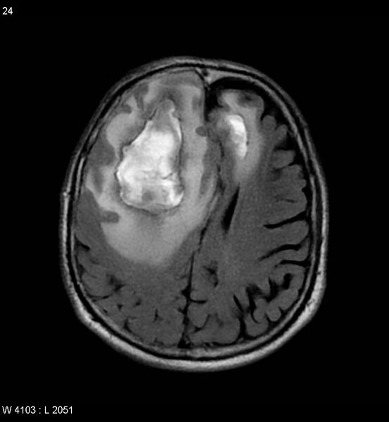 File:Cerebral abscesses secondary to contusions (Radiopaedia 5201-6968 Axial FLAIR 3).jpg