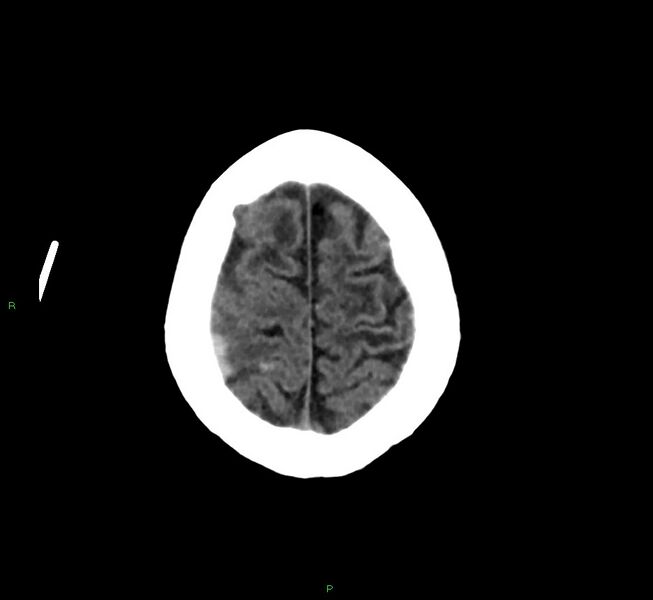 File:Cerebral amyloid angiopathy-associated lobar intracerebral hemorrhage (Radiopaedia 58376-65513 Axial non-contrast 9).jpg