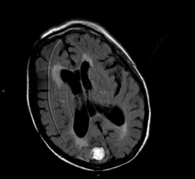 File:Cerebral amyloid angiopathy-associated lobar intracerebral hemorrhage (Radiopaedia 58377-65515 Axial FLAIR 13).jpg