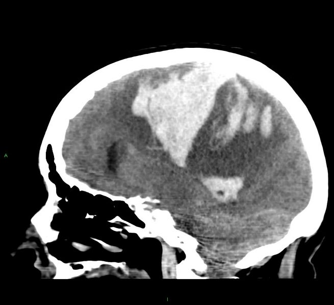 File:Cerebral amyloid angiopathy-associated lobar intracerebral hemorrhage (Radiopaedia 58379-65519 C 24).jpg
