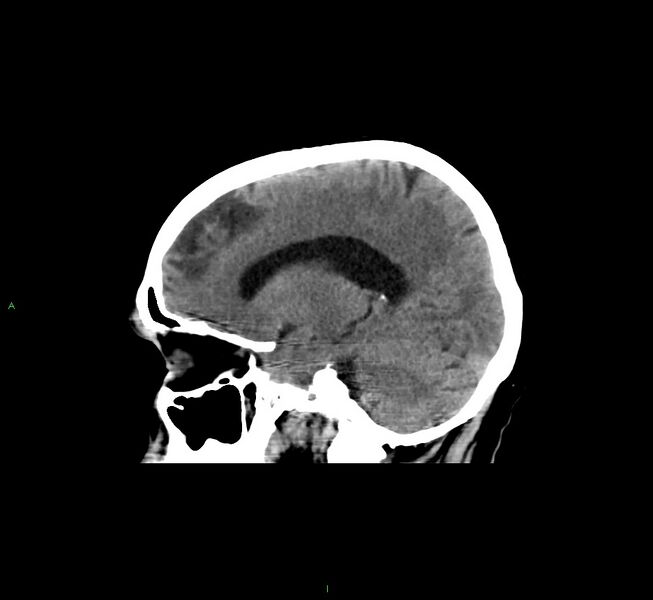 File:Cerebral amyloid angiopathy-associated lobar intracerebral hemorrhage (Radiopaedia 58529-65681 B 19).jpg