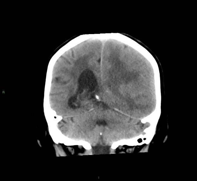 File:Cerebral amyloid angiopathy-associated lobar intracerebral hemorrhage (Radiopaedia 58561-65724 Coronal non-contrast 24).jpg
