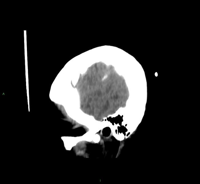 File:Cerebral amyloid angiopathy-associated lobar intracerebral hemorrhage (Radiopaedia 58566-65730 C 6).jpg