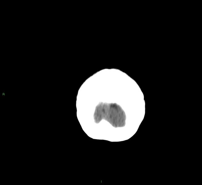 File:Cerebral amyloid angiopathy-associated lobar intracerebral hemorrhage (Radiopaedia 58757-65978 Coronal non-contrast 7).jpg