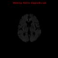 Cerebral and orbital tuberculomas (Radiopaedia 13308-13311 Axial DWI 11).jpg