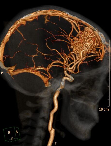 File:Cerebral arteriovenous malformation (Radiopaedia 29531-30031 C 4).jpg