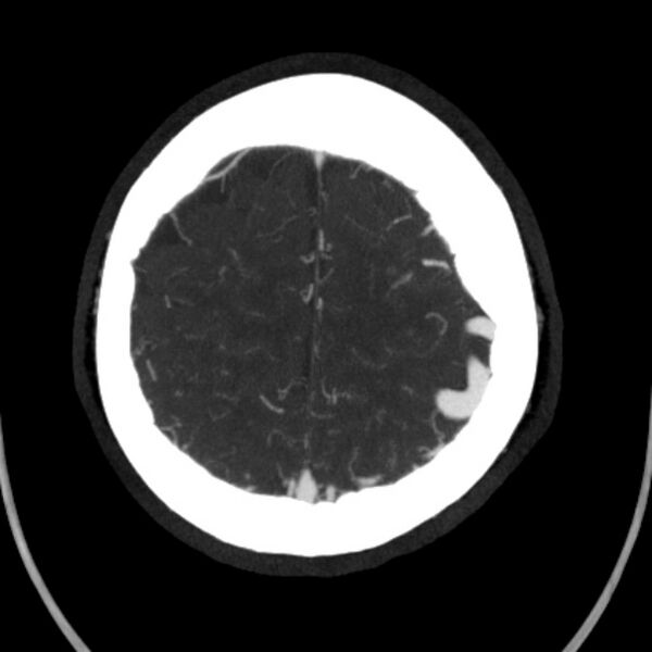 File:Cerebral arteriovenous malformation (Radiopaedia 43729-47189 B 41).jpg