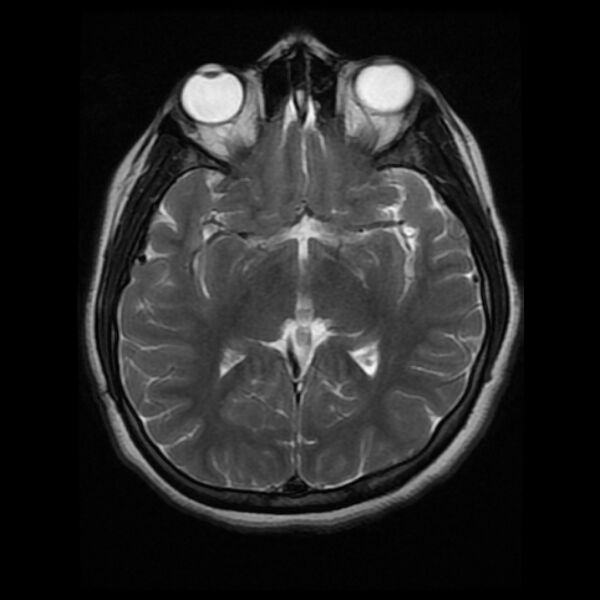 File:Cerebral cavernous malformation (Radiopaedia 44301-47942 Axial T2 10).jpg