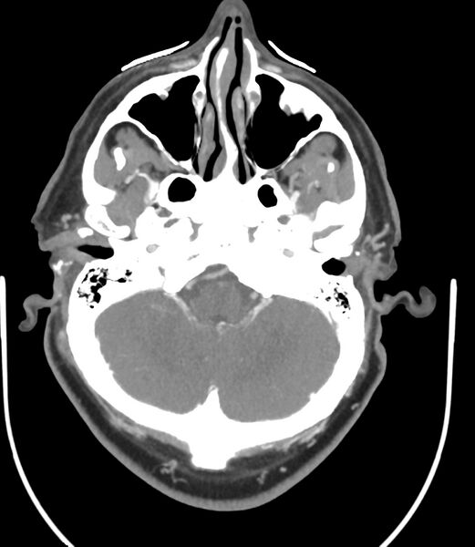 File:Cerebral dural venous sinus thrombosis (Radiopaedia 86514-102576 A 32).jpg