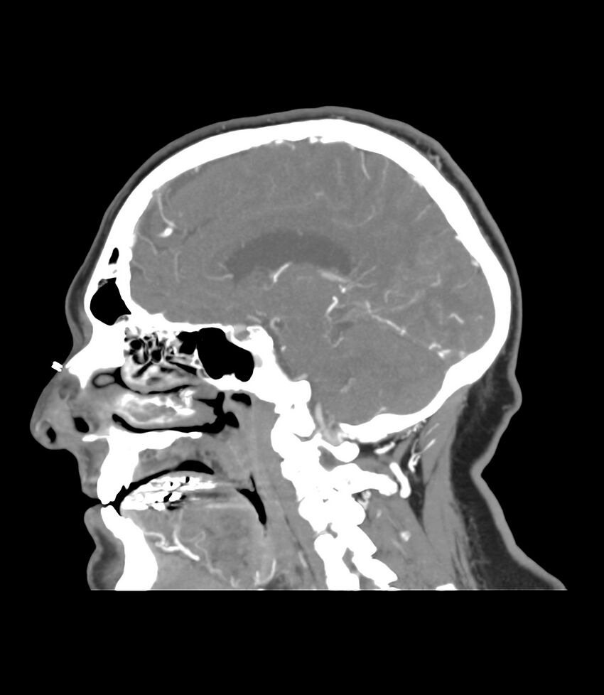 Cerebral dural venous sinus thrombosis (Radiopaedia 86514-102576 C 32).jpg