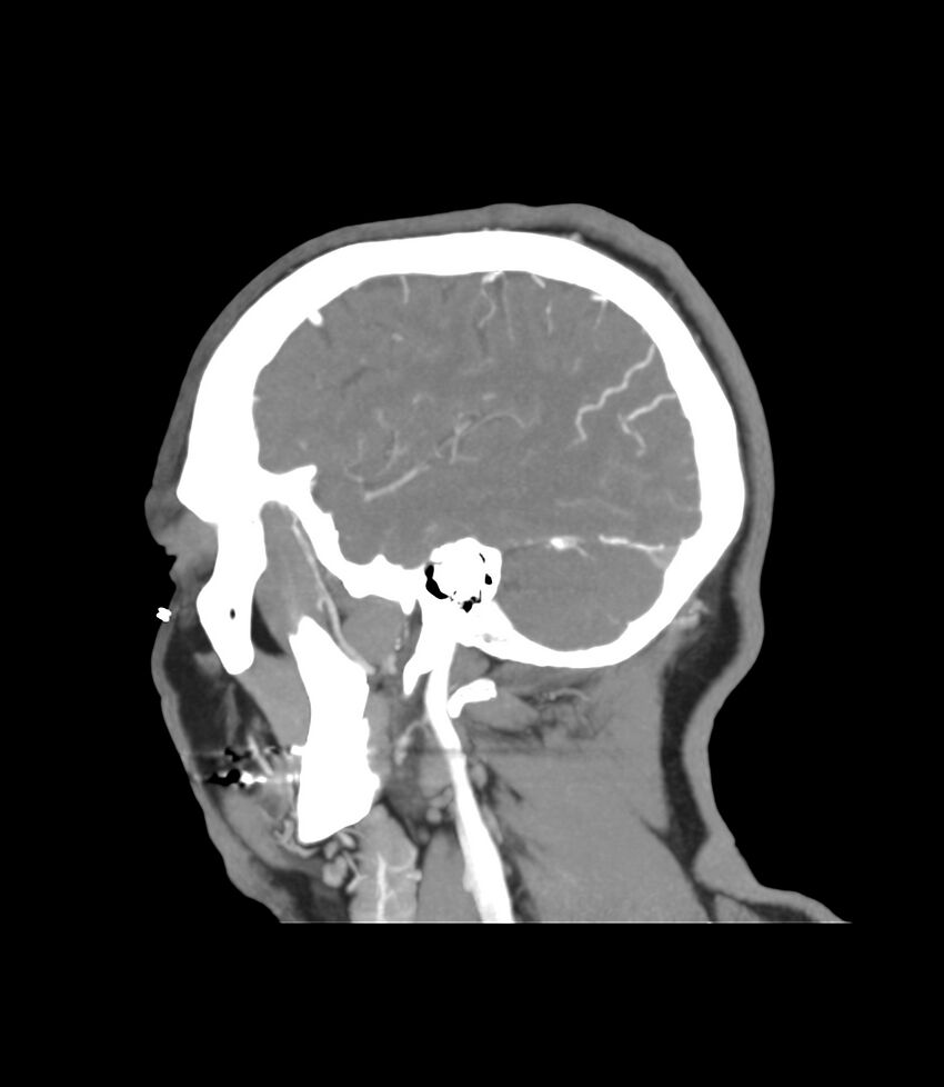 Cerebral dural venous sinus thrombosis (Radiopaedia 86514-102576 C 8).jpg