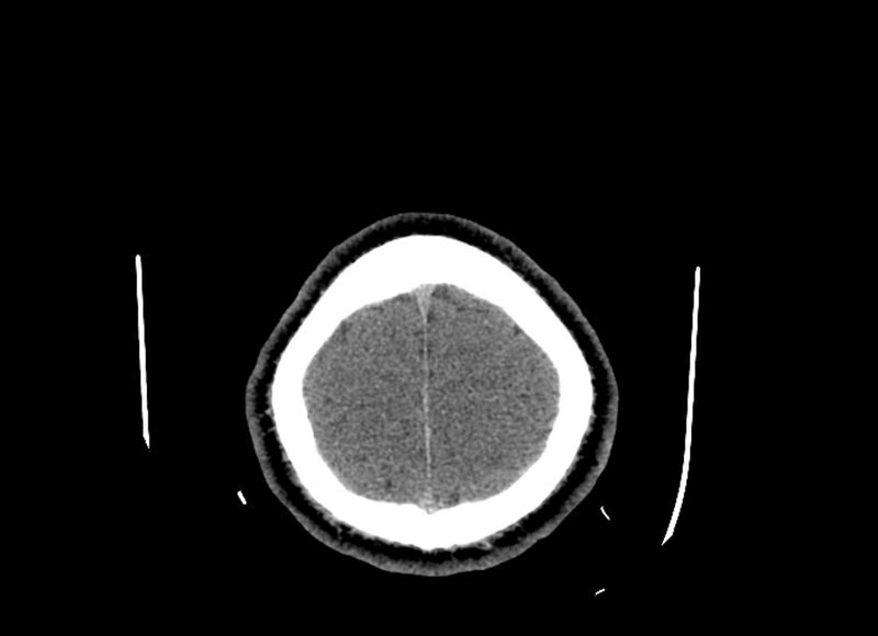 File:Cerebral edema (Radiopaedia 82519-96661 Axial non-contrast 8).jpg
