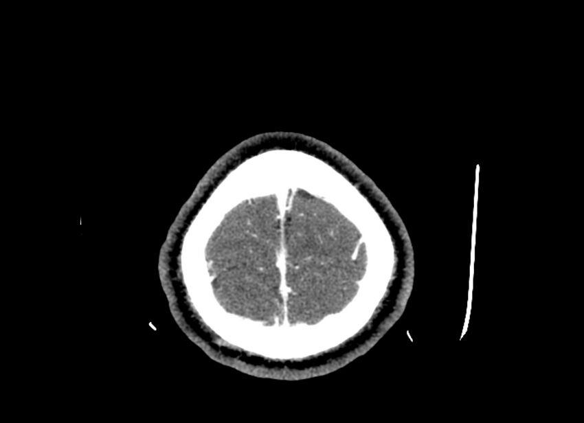Cerebral edema (Radiopaedia 82519-96661 B 9).jpg