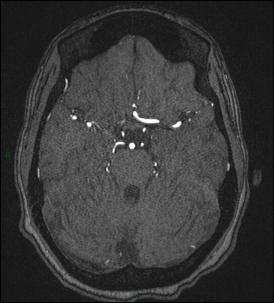 File:Cerebral fat embolism (Radiopaedia 35022-36525 Axial TOF 70).jpg