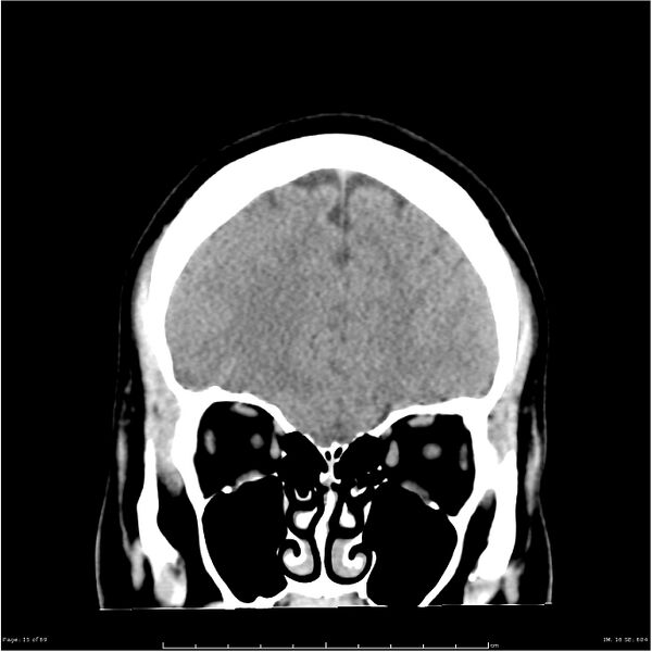 File:Cerebral hemorrhage secondary to arteriovenous malformation (Radiopaedia 33497-34561 Coronal non-contrast 6).jpg