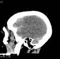 Cerebral hemorrhagic contusion with subdural and subarachnoid hemorrhage (Radiopaedia 10680-11146 C 20).jpg