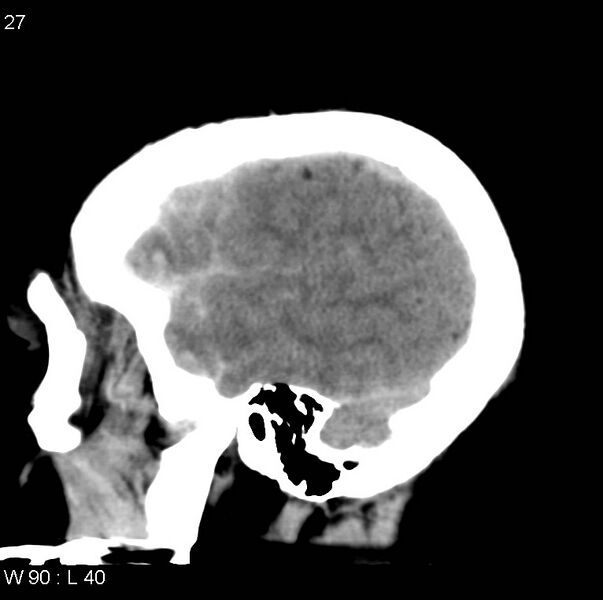 File:Cerebral hemorrhagic contusion with subdural and subarachnoid hemorrhage (Radiopaedia 10680-11146 C 20).jpg