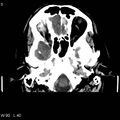 Cerebral hemorrhagic contusion with subdural and subarachnoid hemorrhage (Radiopaedia 10680-19197 Axial non-contrast 1).jpg