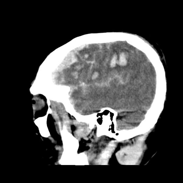 File:Cerebral hemorrhagic contusions (Radiopaedia 23145-23188 C 35).jpg