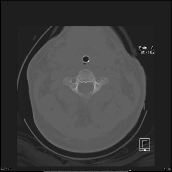 File:Cerebral hemorrhagic contusions and cervical spine fractures (Radiopaedia 32865-33841 C 11).jpg