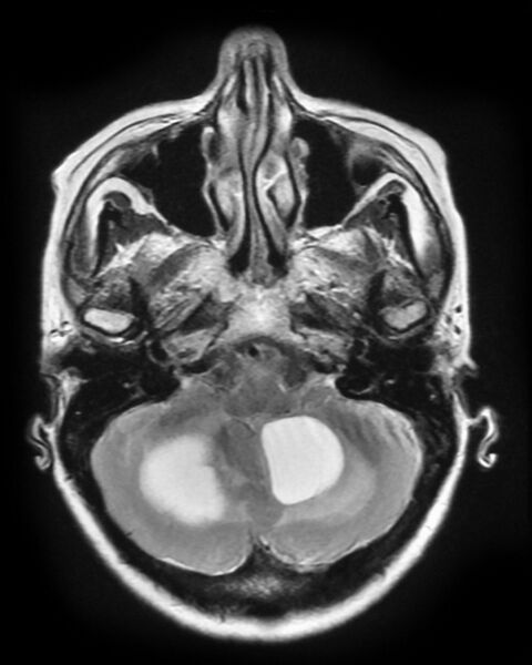 File:Cerebral metastases - small cell lung cancer (Radiopaedia 3972-6521 Axial T2 1).jpg