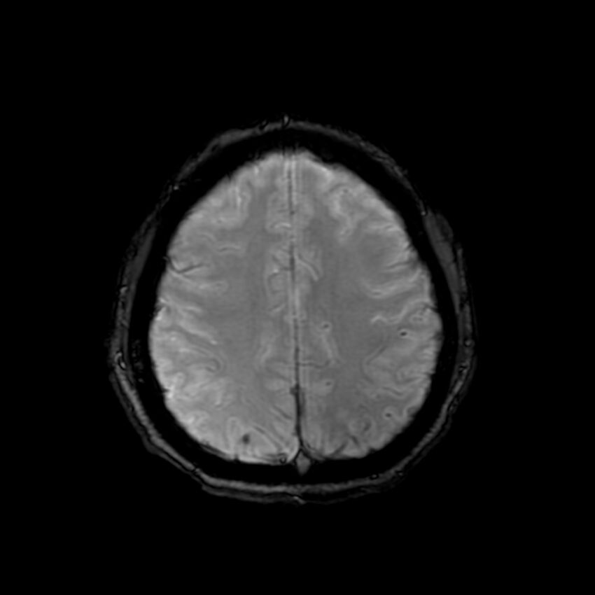 Cerebral paragonimiasis (Radiopaedia 73473-84238 Axial SWI 51).jpg