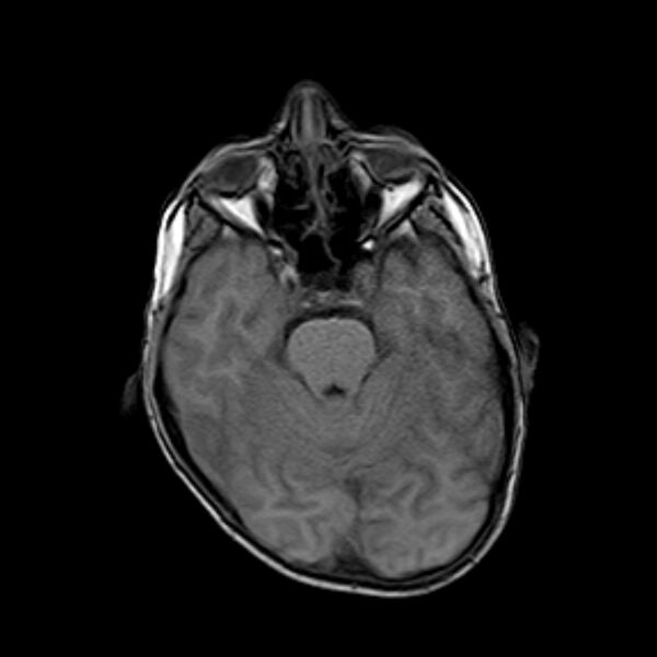 File:Cerebral tuberculoma (Radiopaedia 41152-43932 Axial T1 7).jpg