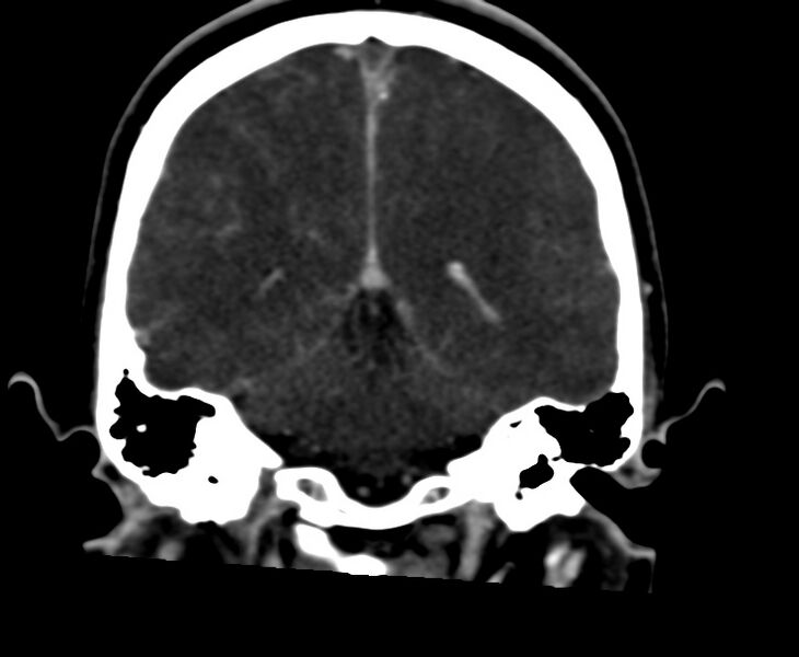 File:Cerebral venous sinus thrombosis (Radiopaedia 59224-66646 Coronal C+ delayed 50).jpg