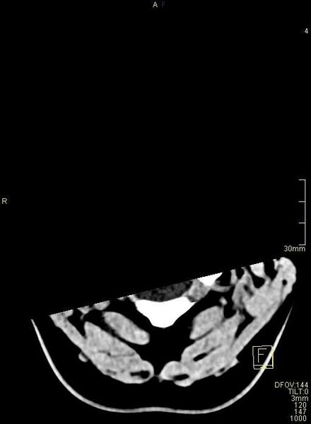File:Cerebral venous sinus thrombosis (Radiopaedia 91329-108965 Axial non-contrast 2).jpg