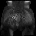 Cervical carcinoma (Radiopaedia 78847-91705 J 13).jpg