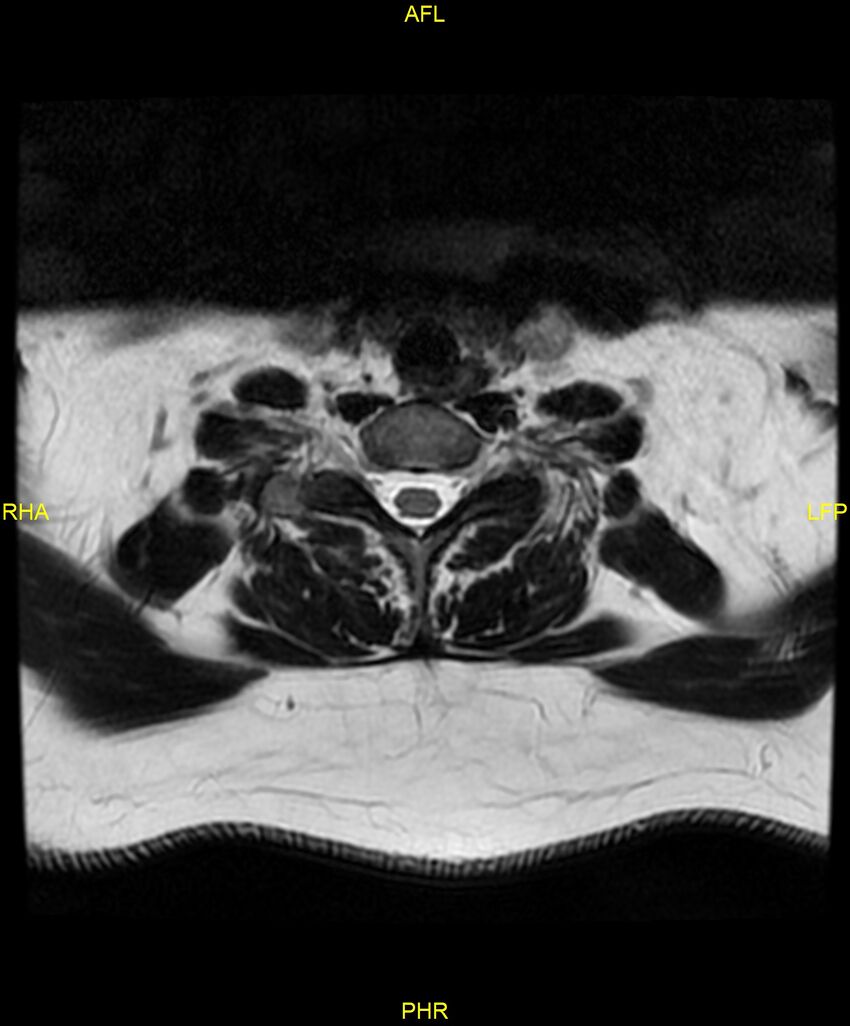 Cervical disc protrusion (Radiopaedia 87147-103415 Axial T2 63).jpg
