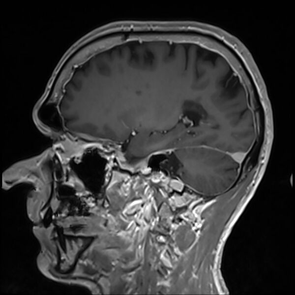 File:Cervical dural CSF leak on MRI and CT treated by blood patch (Radiopaedia 49748-54995 G 35).jpg