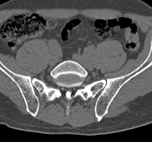 File:Cervical dural CSF leak on MRI and CT treated by blood patch (Radiopaedia 49748-54996 B 117).png