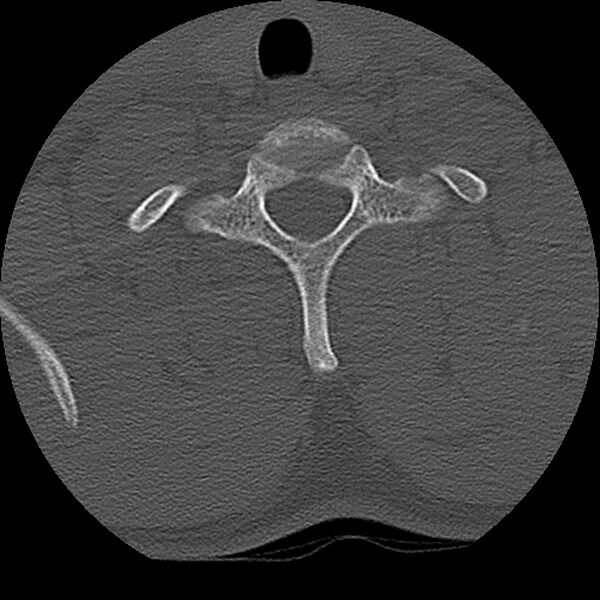 File:Cervical flexion teardrop fracture with cord hemorrhage (Radiopaedia 32497-33454 Axial bone window 73).jpg