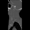 Cervical spine fractures with vertebral artery dissection (Radiopaedia 32135-33078 Sagittal bone window 36).jpg