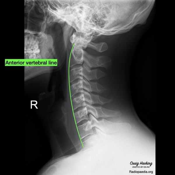 File:Cervical spine lines (Radiopaedia 76069-87571 D 1).jpeg