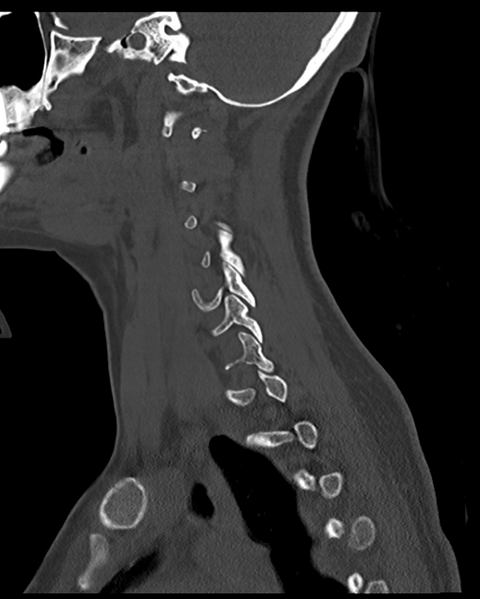 File:Cervical tuberculous spondylitis (Radiopaedia 39149-41365 Sagittal bone window 21).png