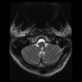 Cervical vertebrae metastasis (Radiopaedia 78814-91667 Axial T2 29).png