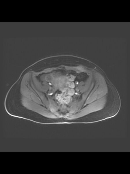 File:Cesarean section scar endometrioma (Radiopaedia 56569-63297 Axial T1 C+ fat sat 29).jpg
