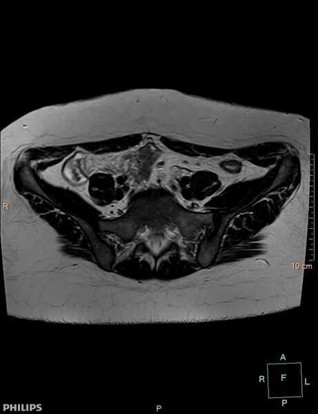 File:Cesarian scar endometriosis (Radiopaedia 68495-78066 Axial T2 2).jpg