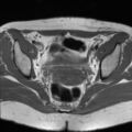 Cesarian section scar endometriosis (Radiopaedia 66520-75799 Axial T1 12).jpg