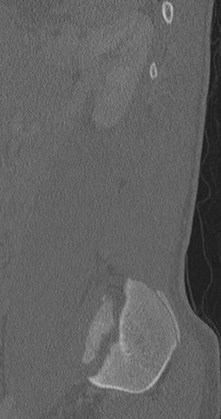 File:Chance fracture (Radiopaedia 40360-42912 Sagittal bone window 19).png